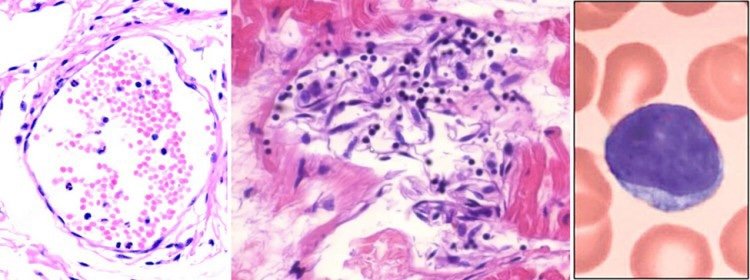 f55119_4fa9ab3c43cd4de197f200fecb932fffmv2 Vascular and organ damage induced by mRNA vaccines: irrefutable proof of causality