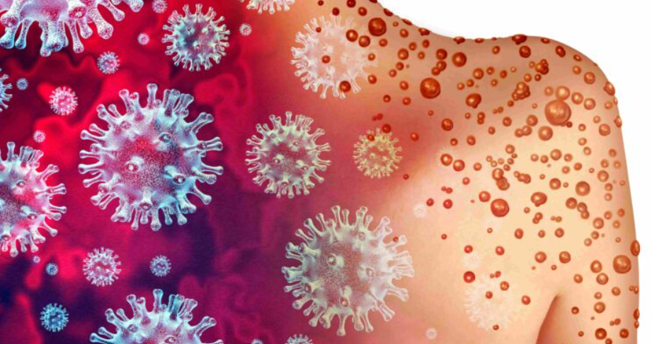 f55119_bd7264dabe30483ab867eecb99425321mv2 Ces épidémies qui surviennent en occident après les injections Covid